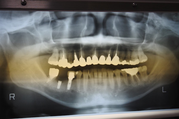 折れてしまったインプラントを見ていただきました。